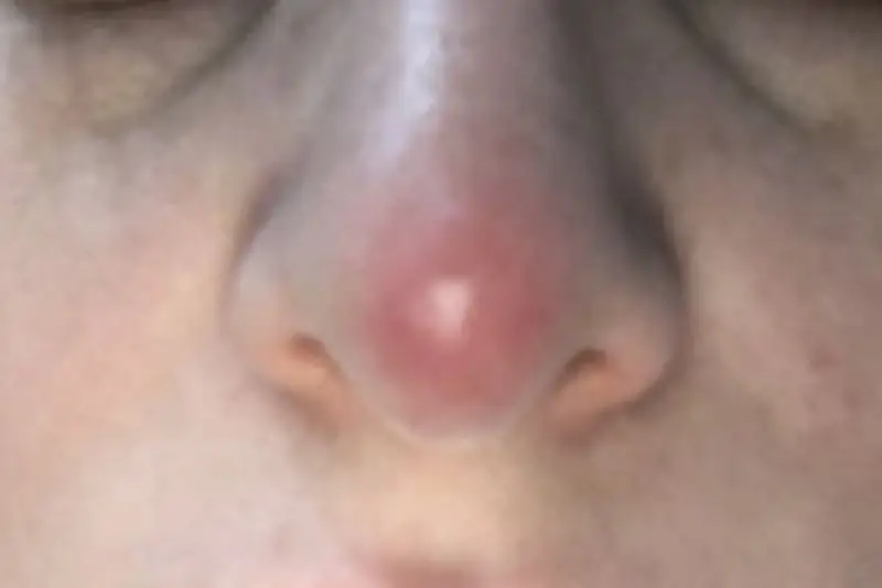 Không trang điểm khi mũi có dấu hiệu sưng đỏ