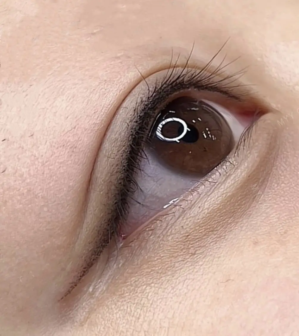 Vùng mí sẽ sưng tấy sau phun mí vài ngày