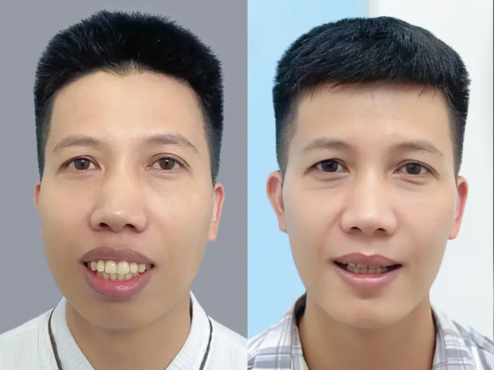 khách hàng trước và sau khi chỉnh hàm hô tại kangnam, phục hồi nhanh, không đau, kết quả ổn định