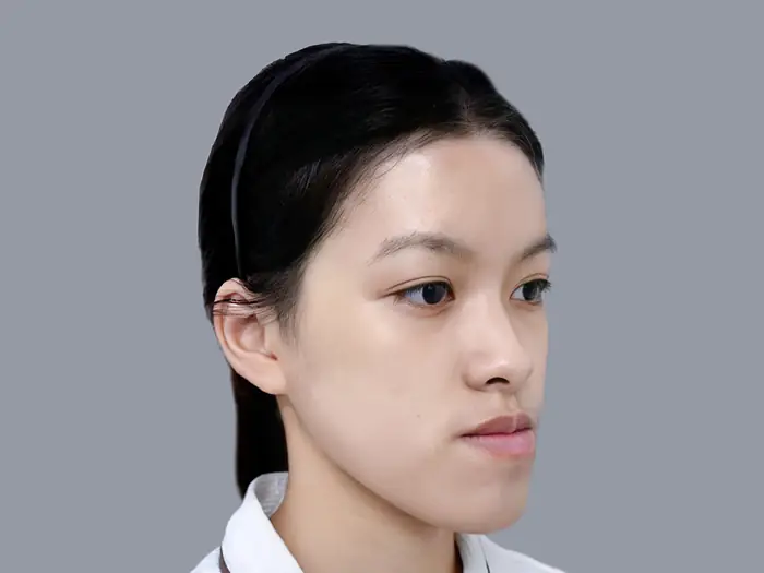 khách hàng Kangnam gặp tình trạng móm do xương, hàm dưới nhô ra trước hàm trên