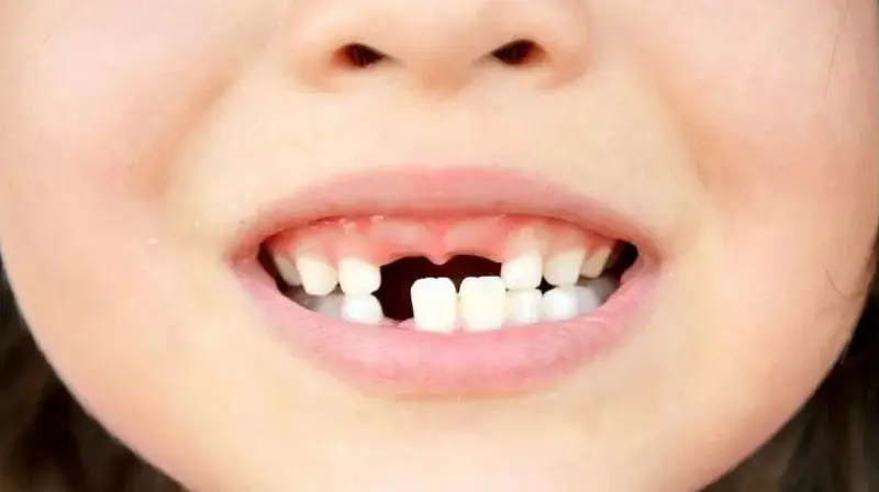 Trẻ em không nên trồng răng quá sớm sẽ ảnh hưởng đến sự phát triển của răng