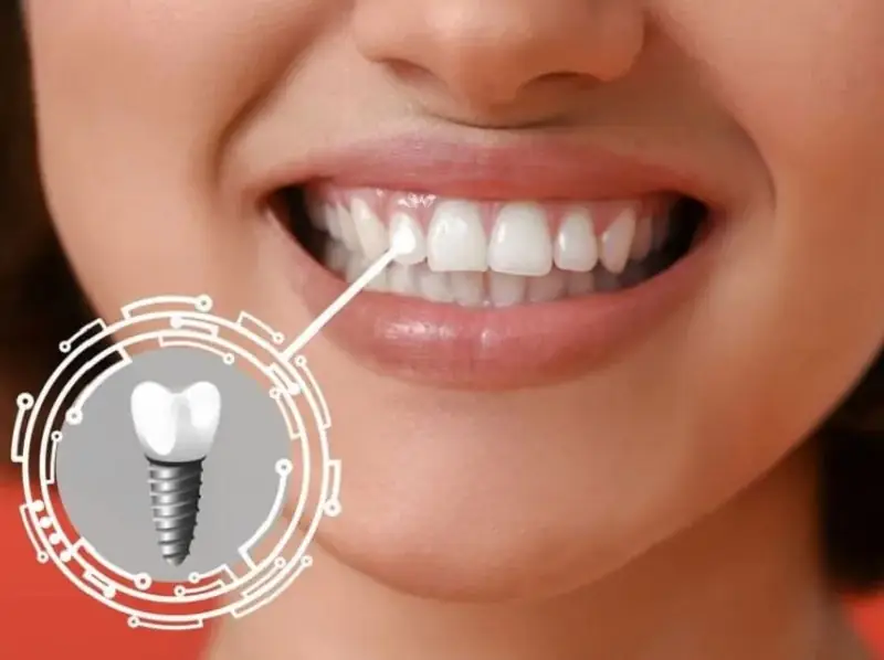 Khi đủ tuổi có thể trồng Implant để cải thiện chức năng ăn nhai và tính thẩm mỹ