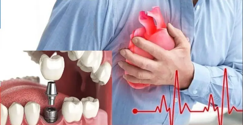 Huyết áp cao nhưng ổn định có thể trồng răng Implant