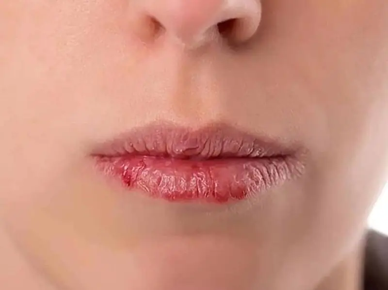 Một số trường hợp nhiễm trùng môi khi chát xát mạnh vào môi