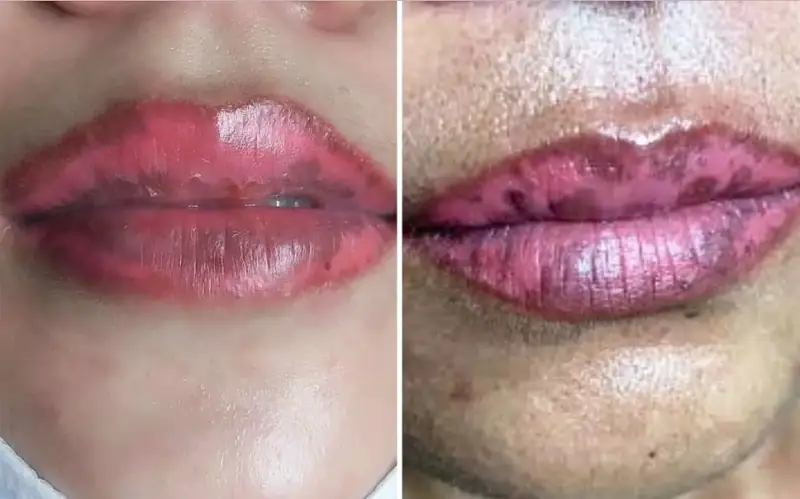 Phun môi sẽ gây loang lổ môi, nhiễm trùng nếu không được thực hiện đúng cách