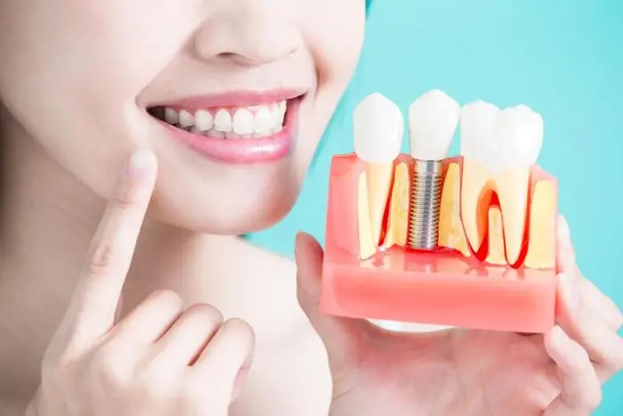 Có thể trồng răng Implant khi đủ tuổi