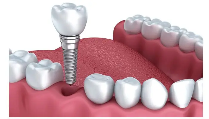 Nếu mật độ xương hàm đủ mới có thể trồng răng