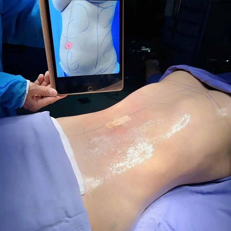 Sau hút mỡ vùng bụng được kích thích tăng sinh collagen giúp da mịn màng, săn chắc