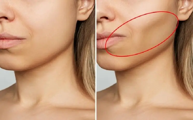 Không trồng răng hàm có thể gây tiêu xương