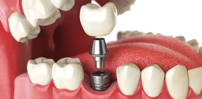 Trồng răng Implant là giải pháp tối ưu hiện nay
