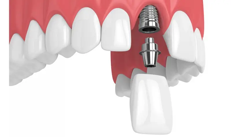 Trồng răng Implant là giải pháp mang lại hiệu quả lâu dài