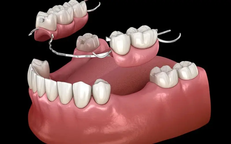 Hàm giả tháo lắp chỉ là giải pháp tạm thời