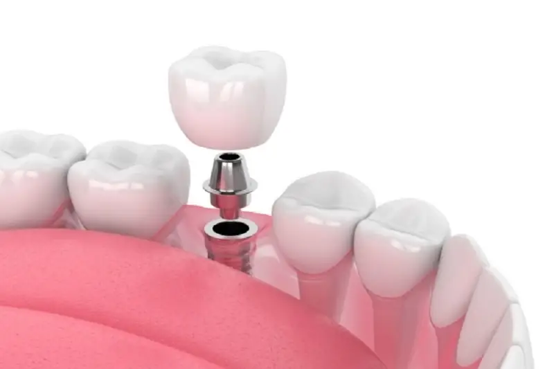 Implant cũng có những nhược điểm khi trồng