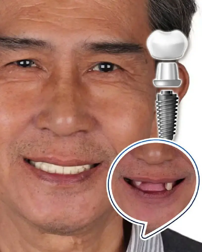 Khách hàng được cấy trụ Implant để cải thiện chức năng ăn nhai