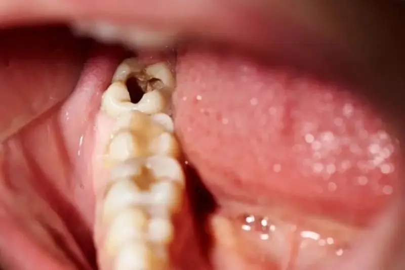 Sâu, vỡ răng hàm có thể phục hình bằng mão sứ Titan