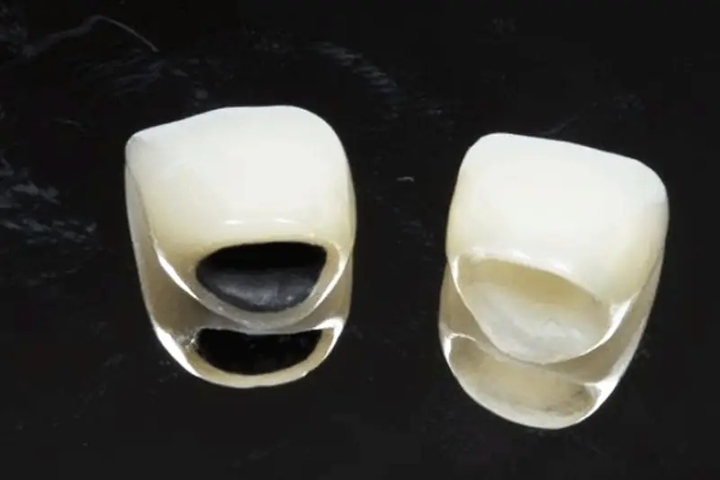Răng sứ kim loại Titan