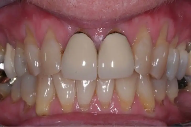 Răng sứ cũ không đảm bảo tính thẩm mỹ