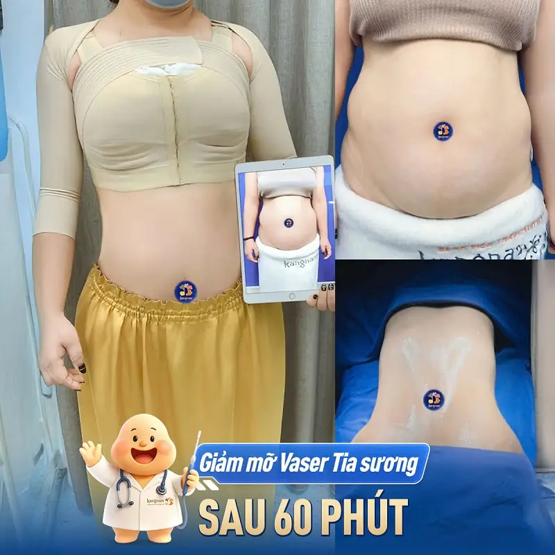 Giảm mỡ tại Kangnam mang lại hiệu quả cao và nhanh chóng