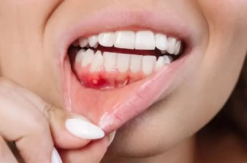 Bệnh viêm nhiễm răng miệng cần được điều trị