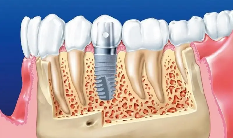 Nếu răng vừa trồng còn sưng đau, nhức thì chưa nên ăn tôm sớm