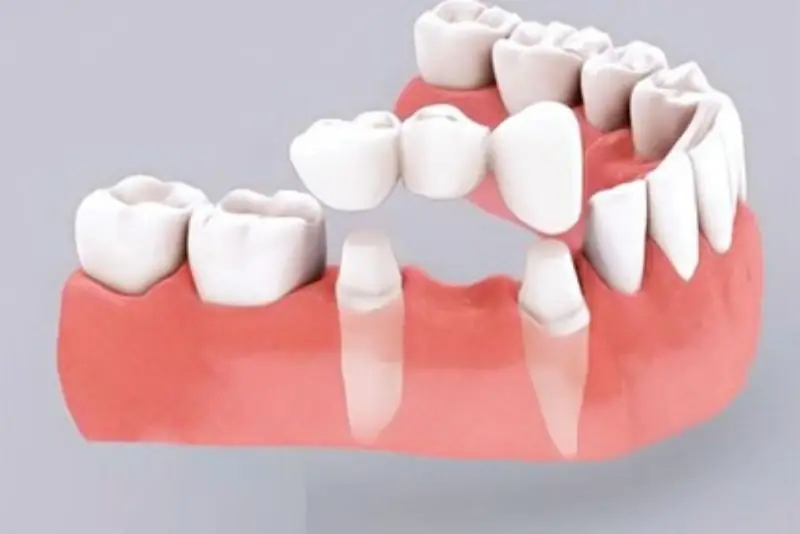 Làm cầu răng sứ
