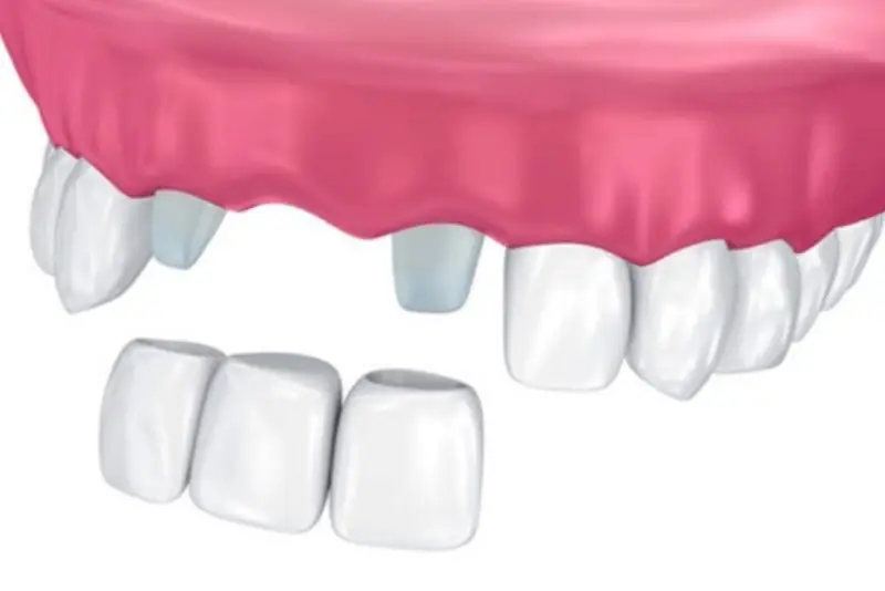 Làm cầu răng sứ trong trường hợp mất 1 răng