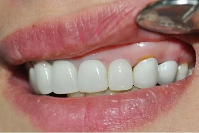 Răng sứ giá rẻ tính thẩm mỹ không cao