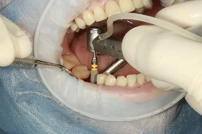 Trồng răng Implant là phương pháp được nhiều người lựa chọn