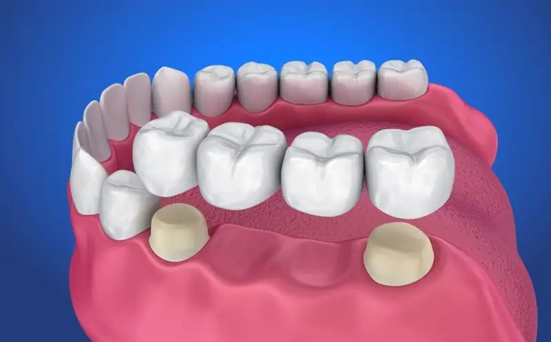 Cầu răng sứ có thể mang lại hiệu quả trong vài năm