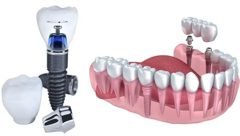 Trồng răng Implant giúp cải thiện chức năng ăn nhai và tính thẩm mỹ