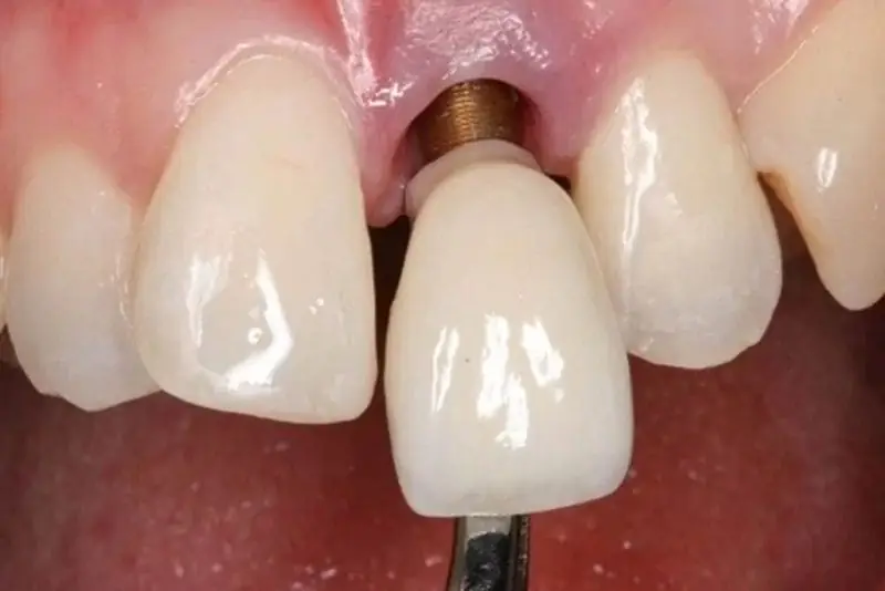 Tháo mão sứ và thay mới để đảm bảo an toàn