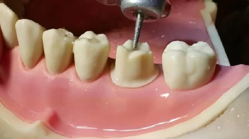 Cảm giác đau nhức có thể xảy ra khi trồng răng