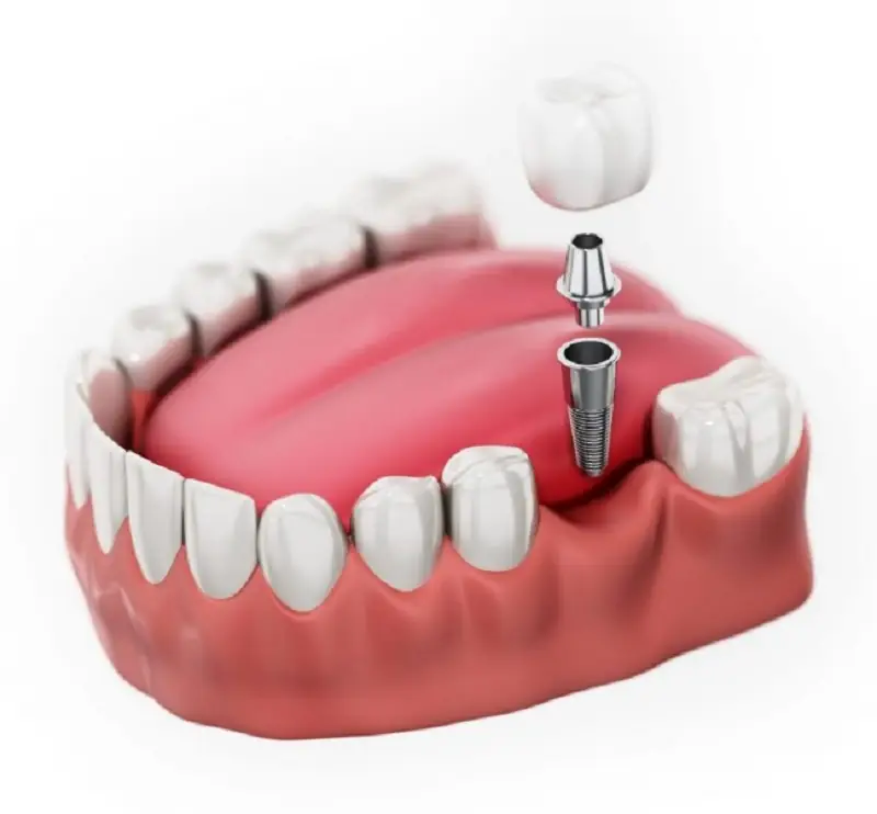 Sau khi trồng răng sau sẽ hơi đau nhức 