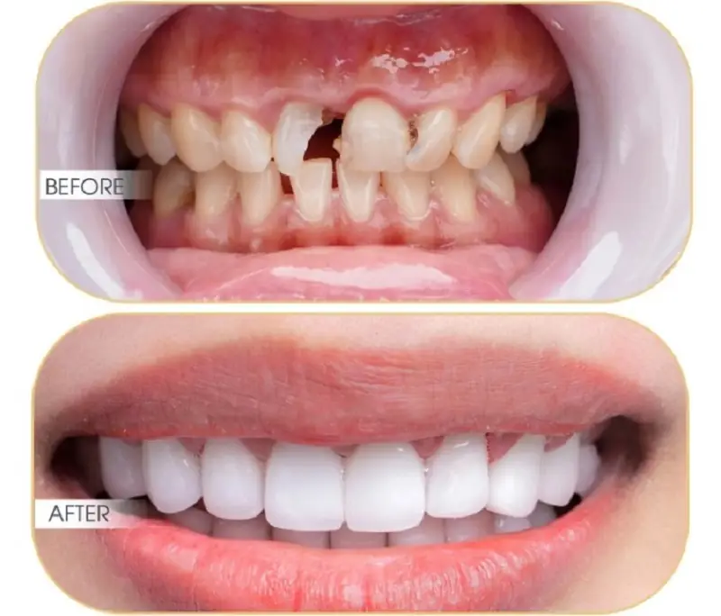 Nếu răng bị sâu, viêm nhiễm thì răng sứ sẽ không được lâu