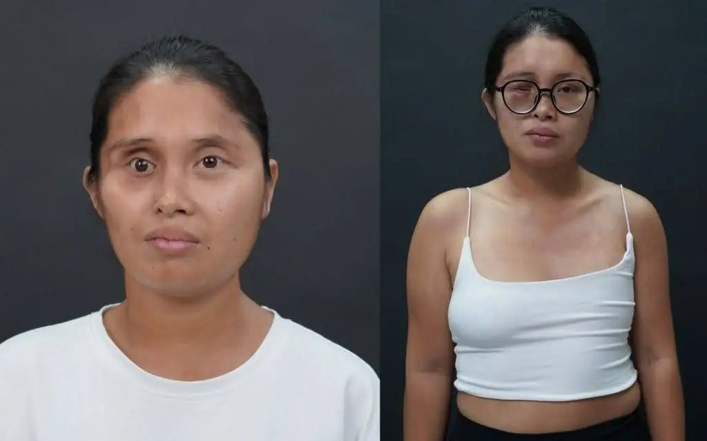 Lê Thị Yến gặp tình trạng gương mặt và vùng ngực không cân đối, teo lép