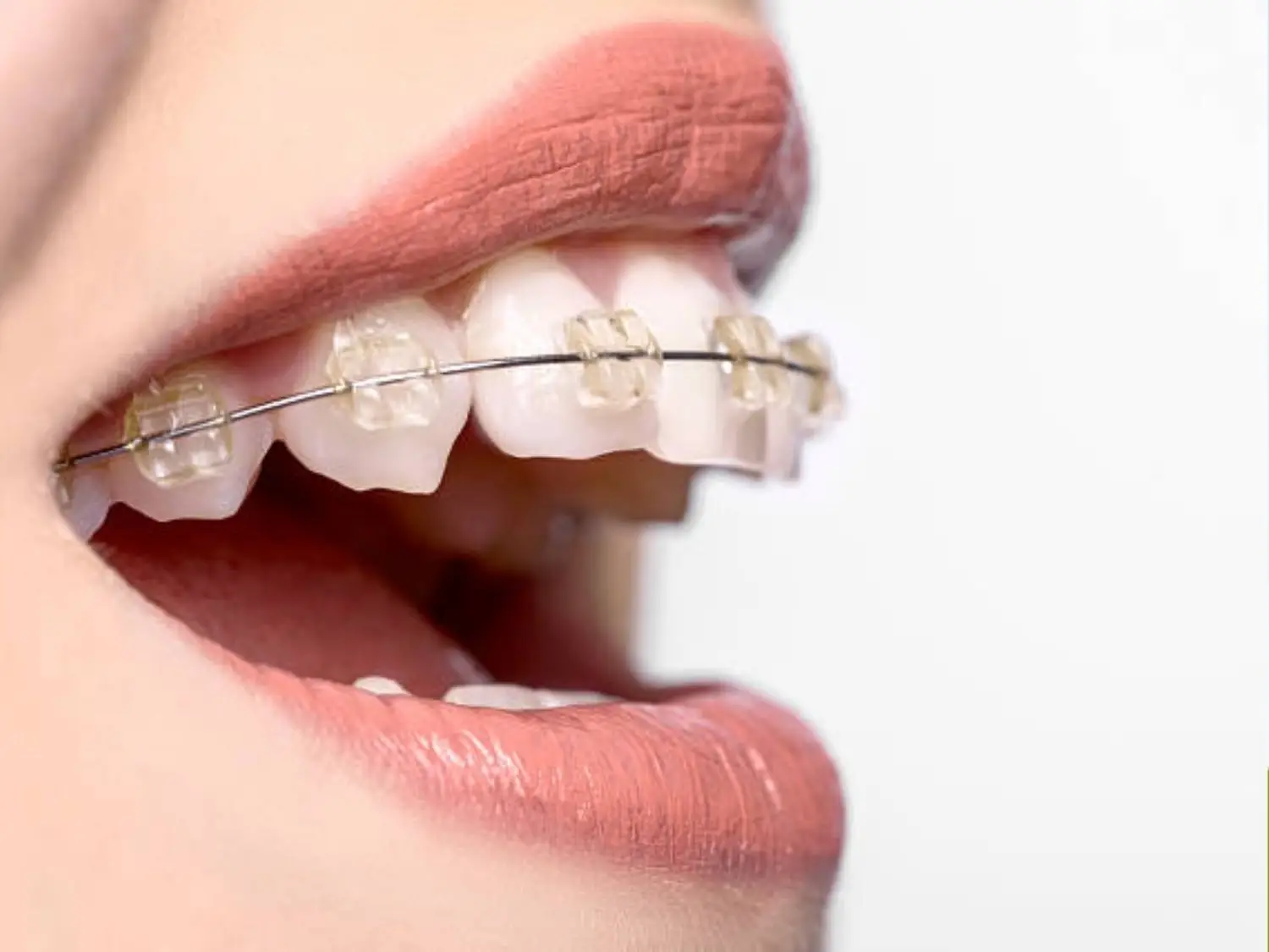 Niềng răng trước, phẫu thuật sau để sắp xếp răng và chuẩn bị khớp cắn, sau đó mới tiến hành phẫu thuật chỉnh hàm