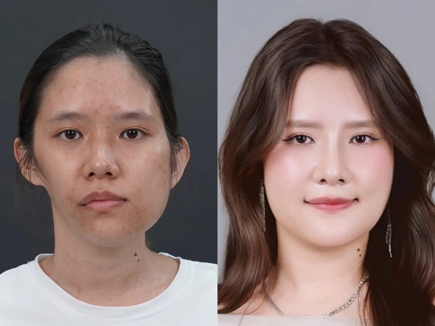 Võ Trần Bảo Ngọc trước và sau khi chỉnh hàm lệch phức tạp