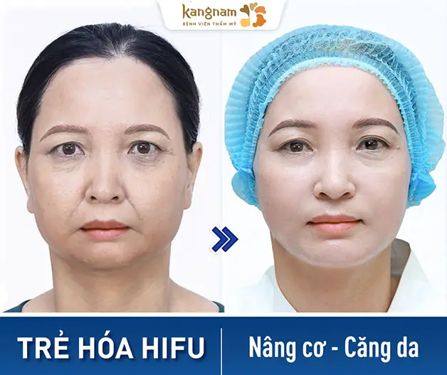 ảnh so sánh trước - sau của Khách hàng thực hiện trẻ hóa da hifu xóa nhăn, nâng cơ lấy lại làn da tươi trẻ