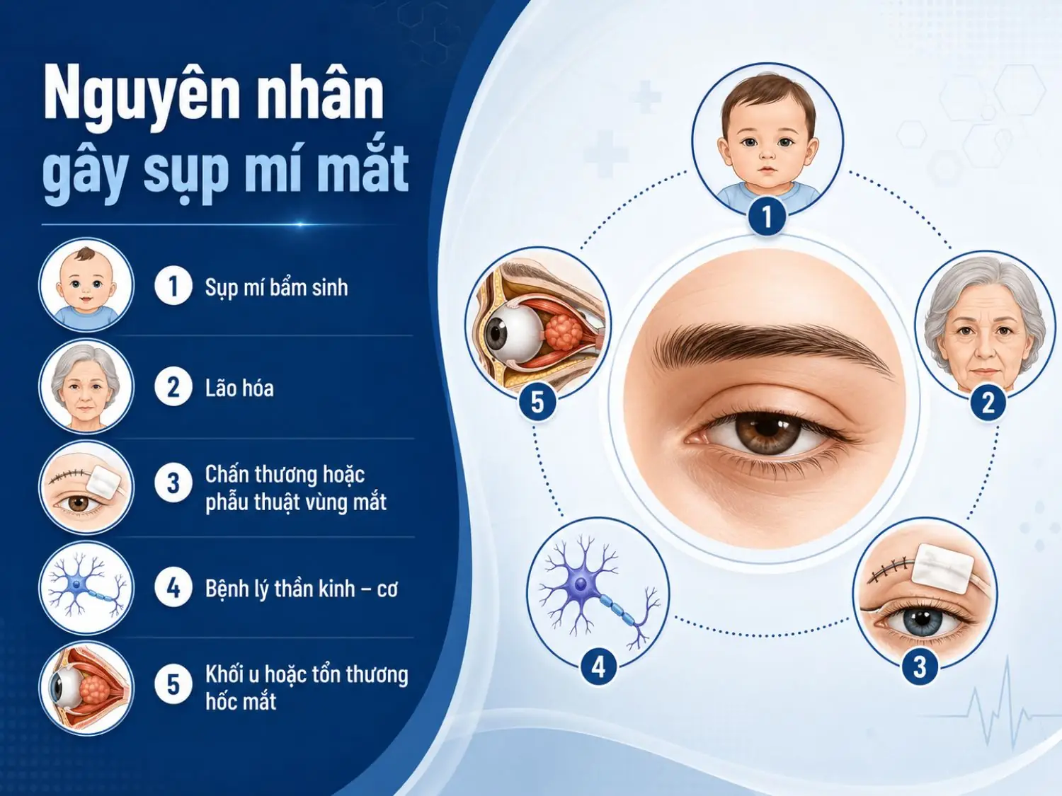 Sụp mí mắt có thể xuất phát từ yếu tố bẩm sinh, quá trình lão hóa, chấn thương hoặc phẫu thuật vùng mắt, bệnh lý thần kinh – cơ và khối u trong hốc mắt.