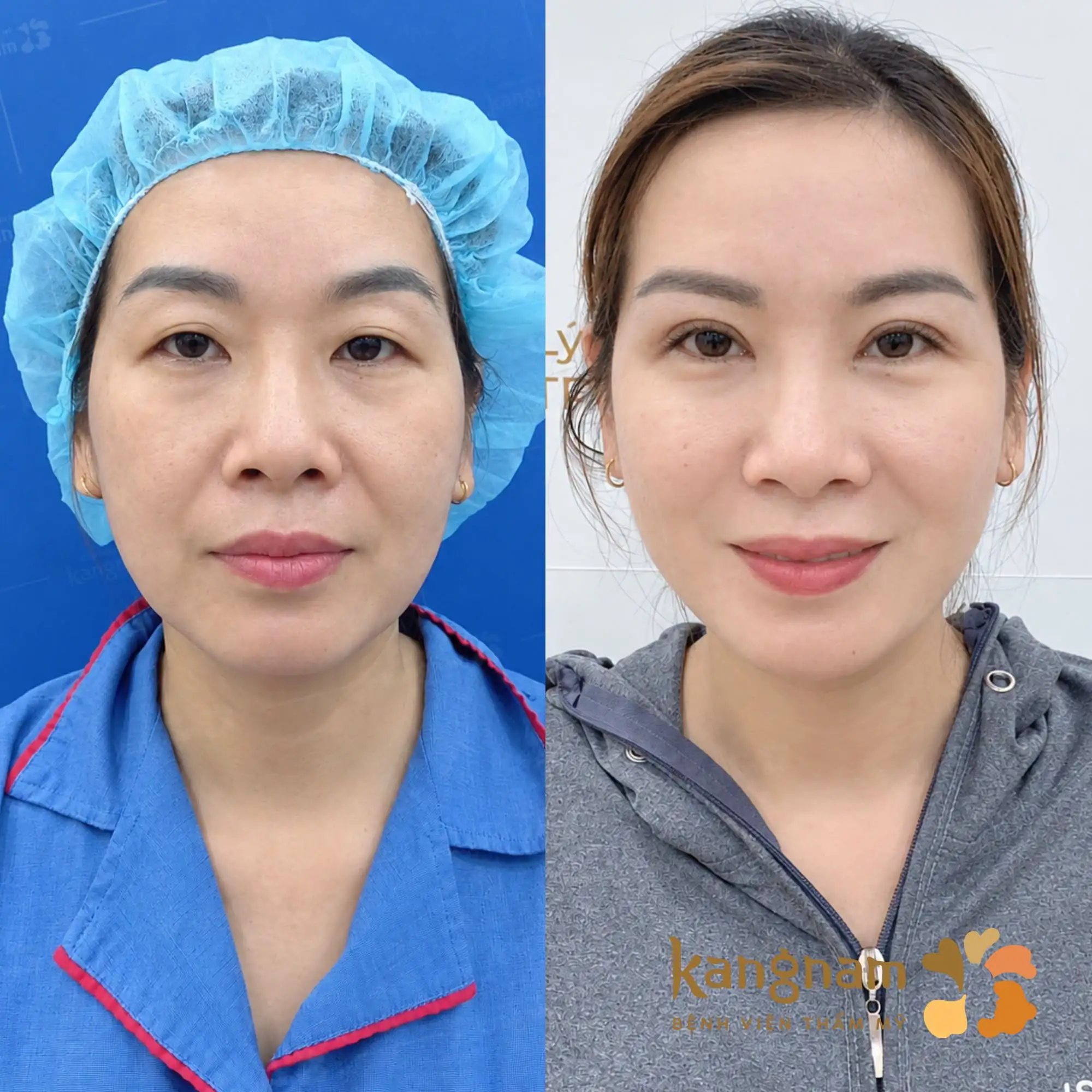 So sánh trước – sau cho thấy nếp mí rõ hơn, vùng da chùng được cải thiện và tổng thể đôi mắt trông gọn, cân đối hơn.