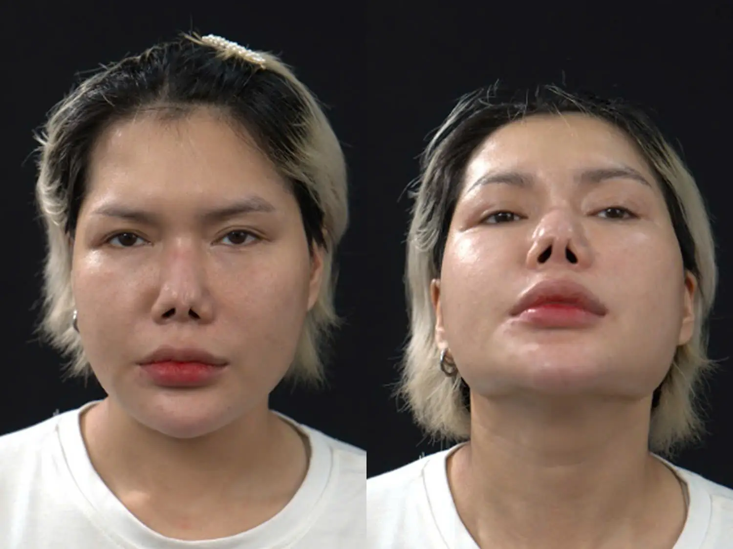 Mũi co rút, biến chứng khi thực hiện tại các cơ sở giá rẻ, không đảm bảo yếu tố bác sĩ, chất lượng sụn