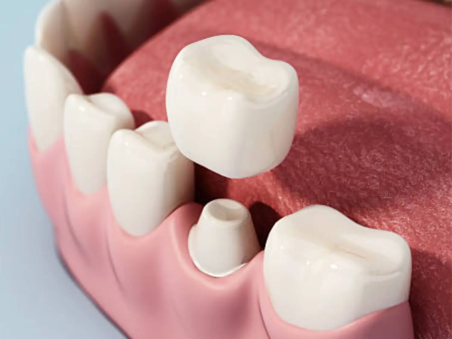Phục hình lại khi răng và nướu ổn định để tăng tính thẩm mỹ và quá trình ăn uống