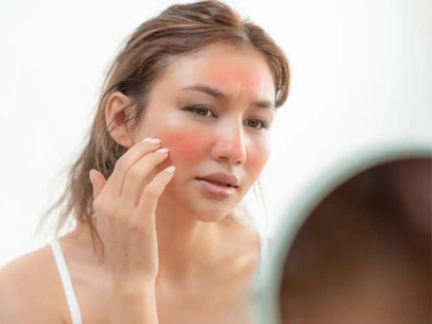 Da tổn thương, đỏ rát sau RF