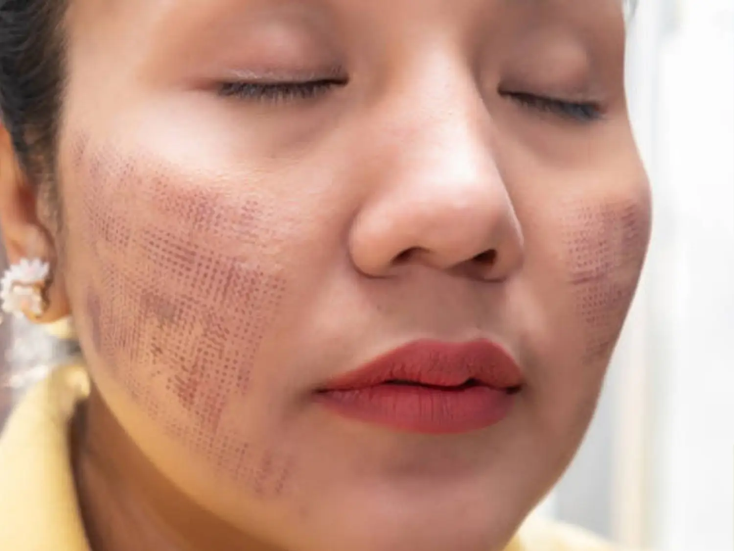 Da vừa tổn thương sau RF không nên tự ý tác động lên da