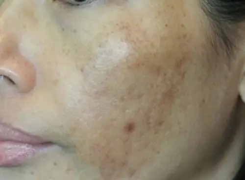 Tăng sắc tố sau laser có thể biểu hiện bằng các đốm hoặc mảng da sẫm màu tại vùng đã điều trị, liên quan đến phản ứng viêm, đặc điểm nền da và quá trình chăm sóc sau laser.