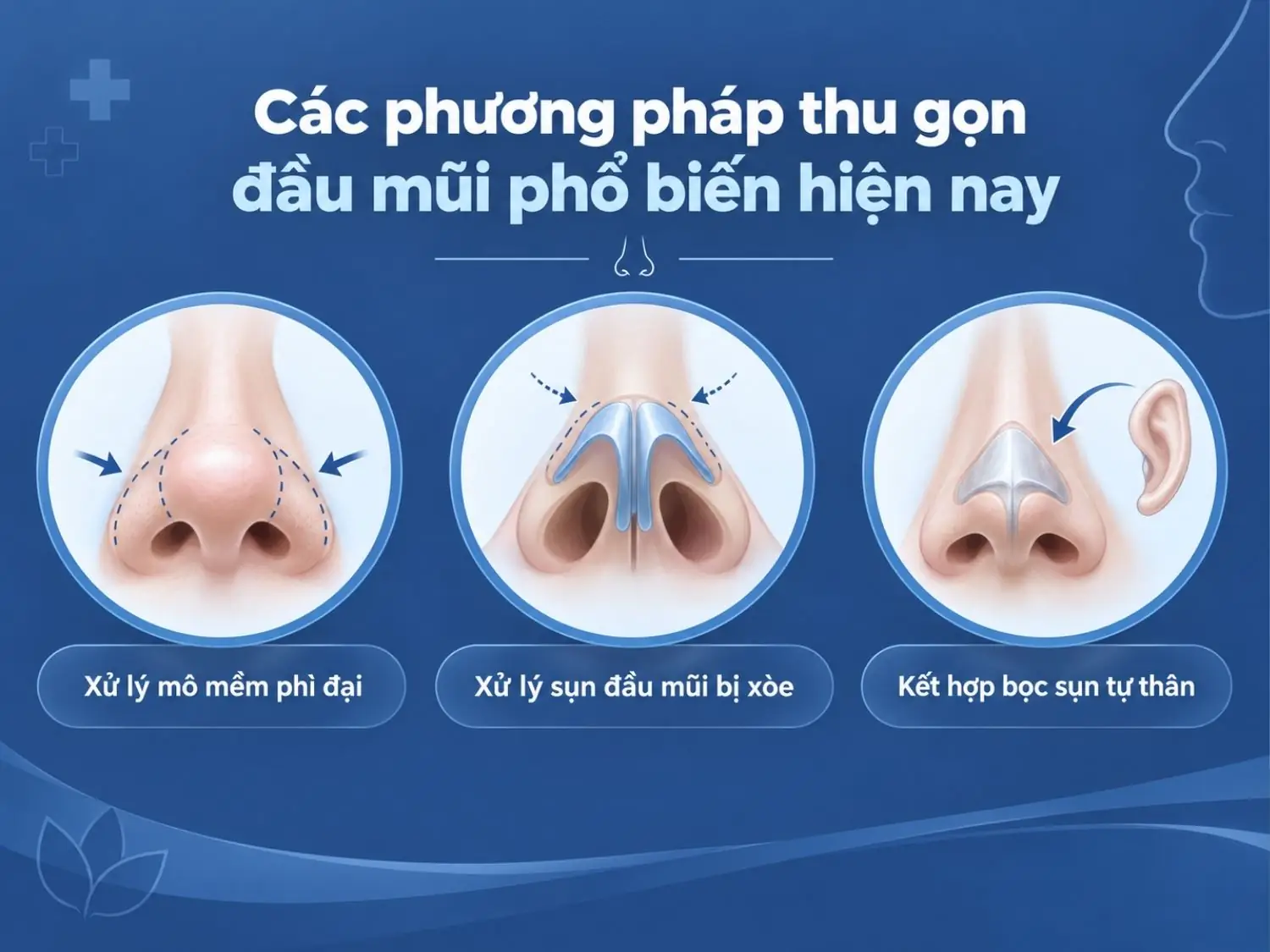 Các phương pháp thu gọn đầu mũi phổ biến hiện nay gồm xử lý mô mềm phì đại, xử lý xụn đầu mũi xòe, kết hợp bọc sụn tự thân