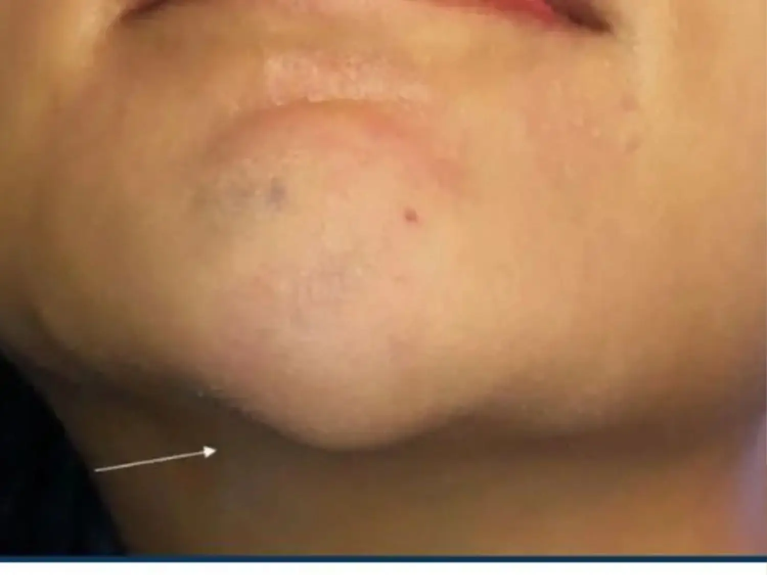 Vùng cằm sưng và nhức sau tiêm filler