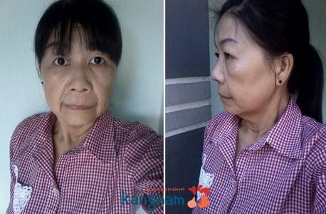 Gương mặt của Như giống bà lão 80 tuổi 