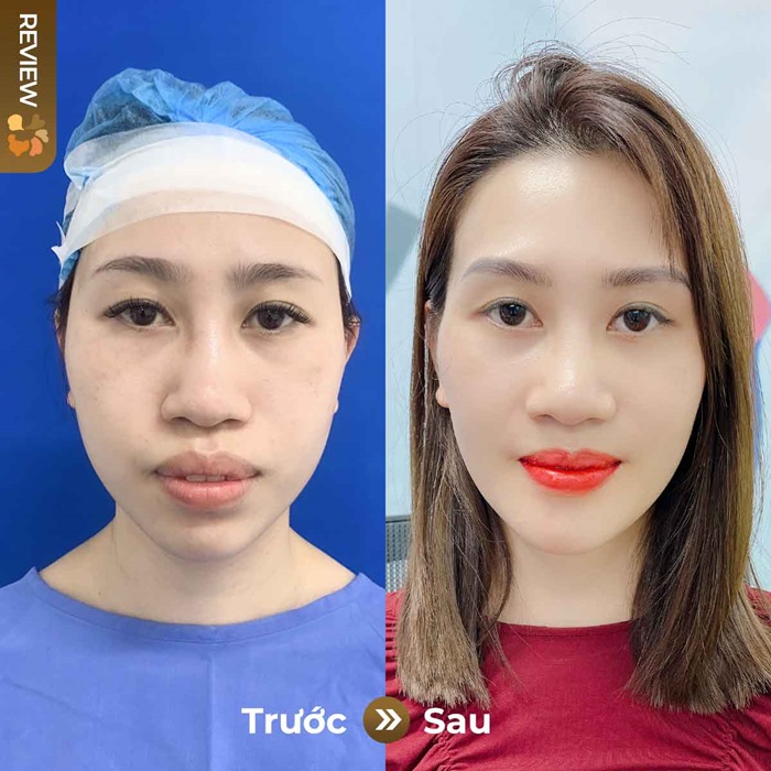 Hình ảnh chị Kim - khách hàng Việt Kiều Mỹ gọt hàm tại Kangnam