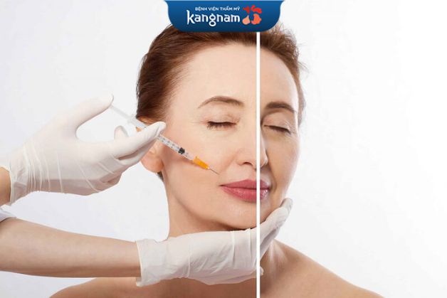 Tiêm chất làm đầy sẽ lấp đầy rãnh nhăn, đem lại sự tươi trẻ cho da